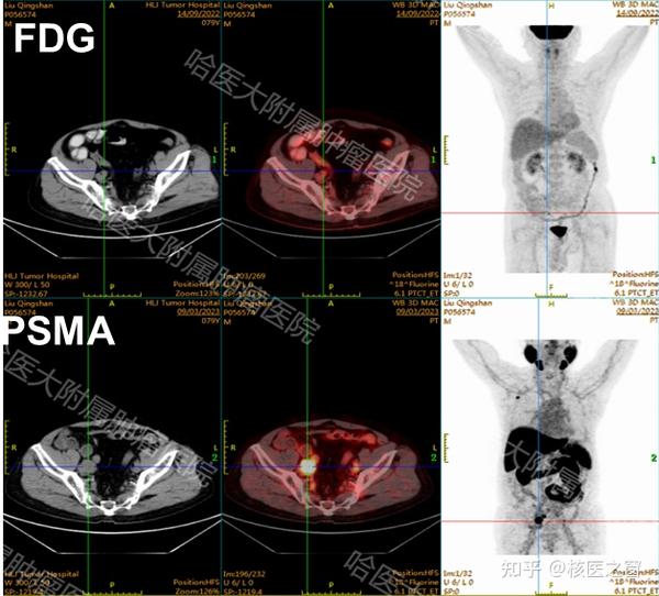 【专家解说】王可铮：“精确制导”PET/CT—18F-PSMA-1007特异性分子探针助力前列腺癌精准诊疗！ - 知乎