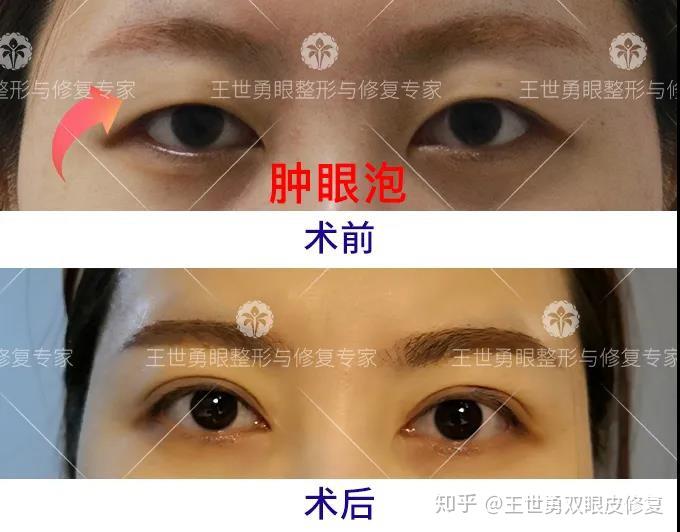 眼球凸出判斷標準:正常人眼球突出度一般在12-14mm,雙眼相差不到2mm