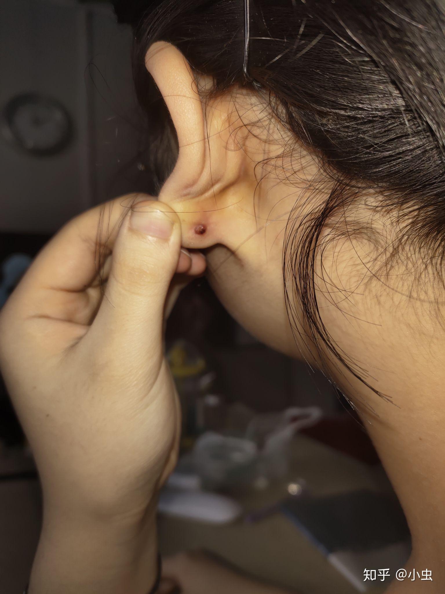 打完耳洞后耳朵后面长了个包,是怎么回事?