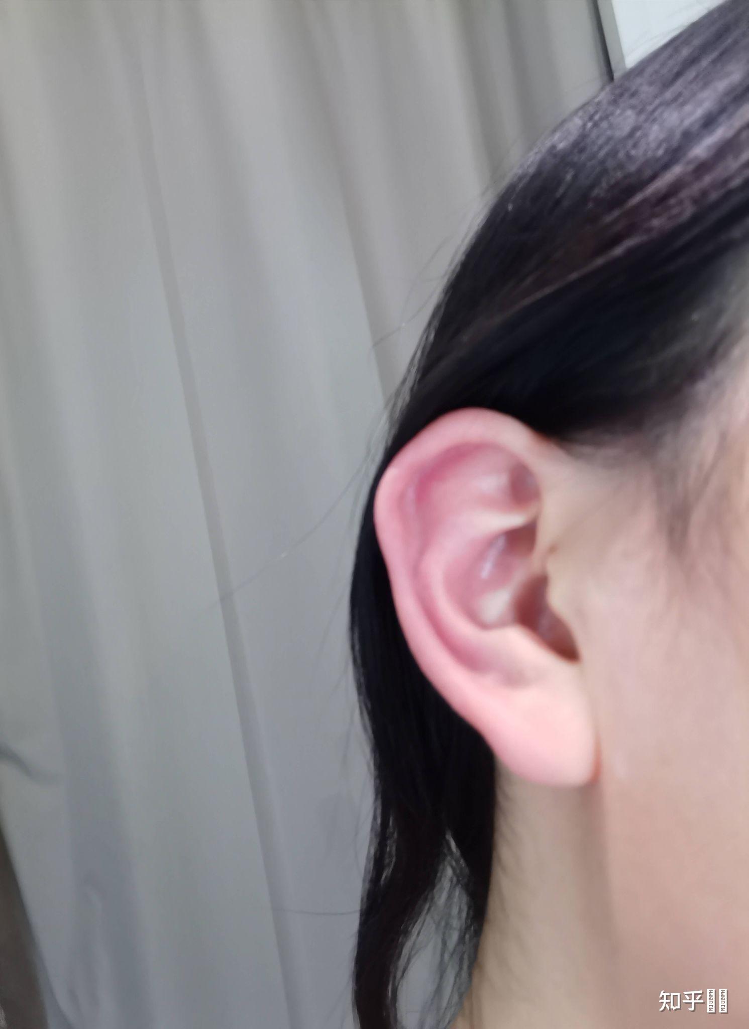 耳朵突然又红又烫怎么回事? - 知乎