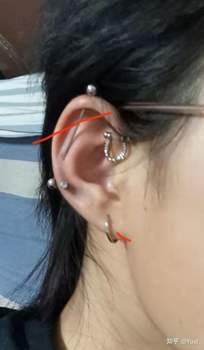 1-Ear bridge耳桥/2-埋钉记录贴 - 知乎