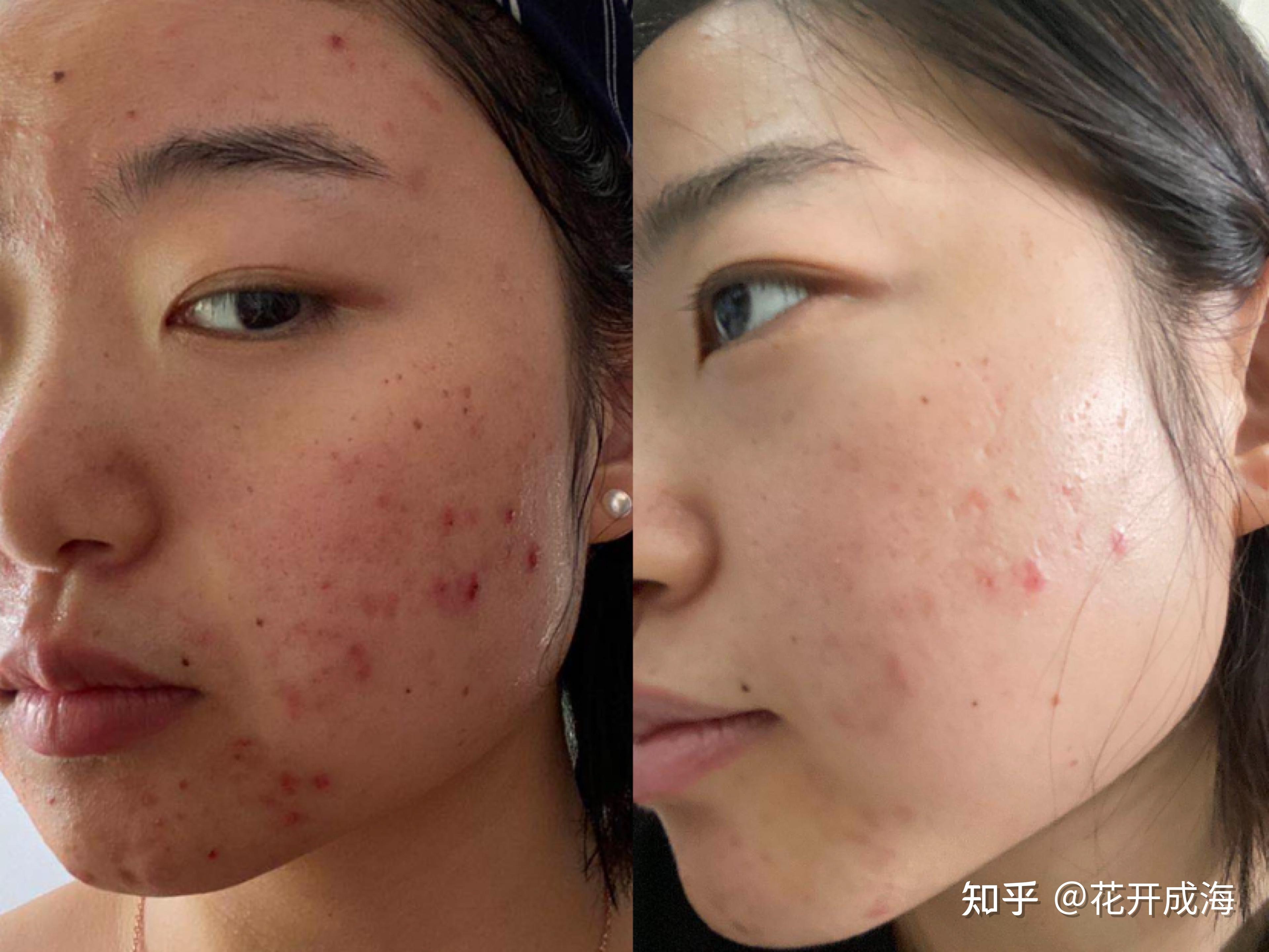 连续做一年光子嫩肤皮肤会有质的飞跃吗
