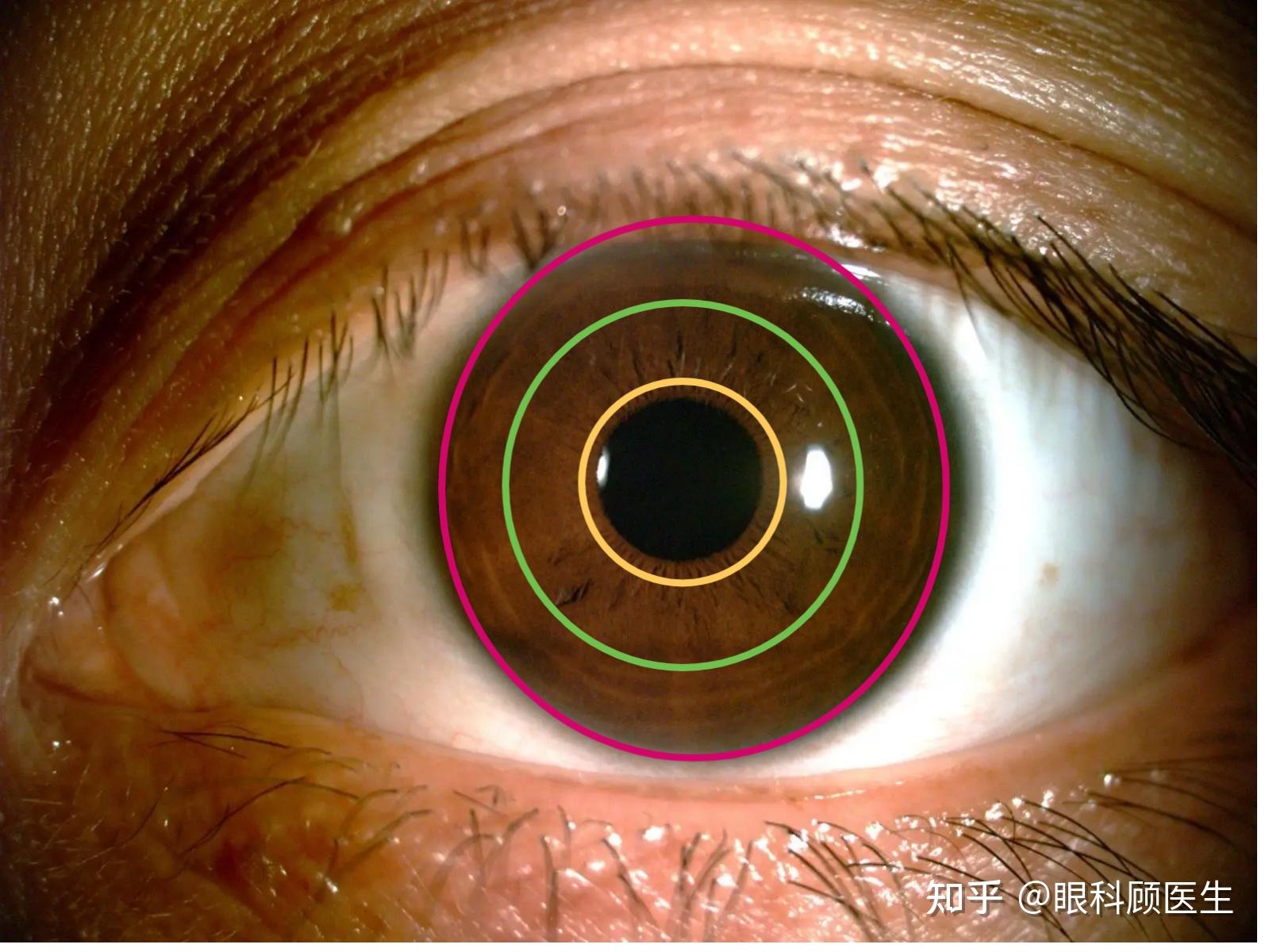 第五节 虹膜嵌顿术-眼科手术-医学