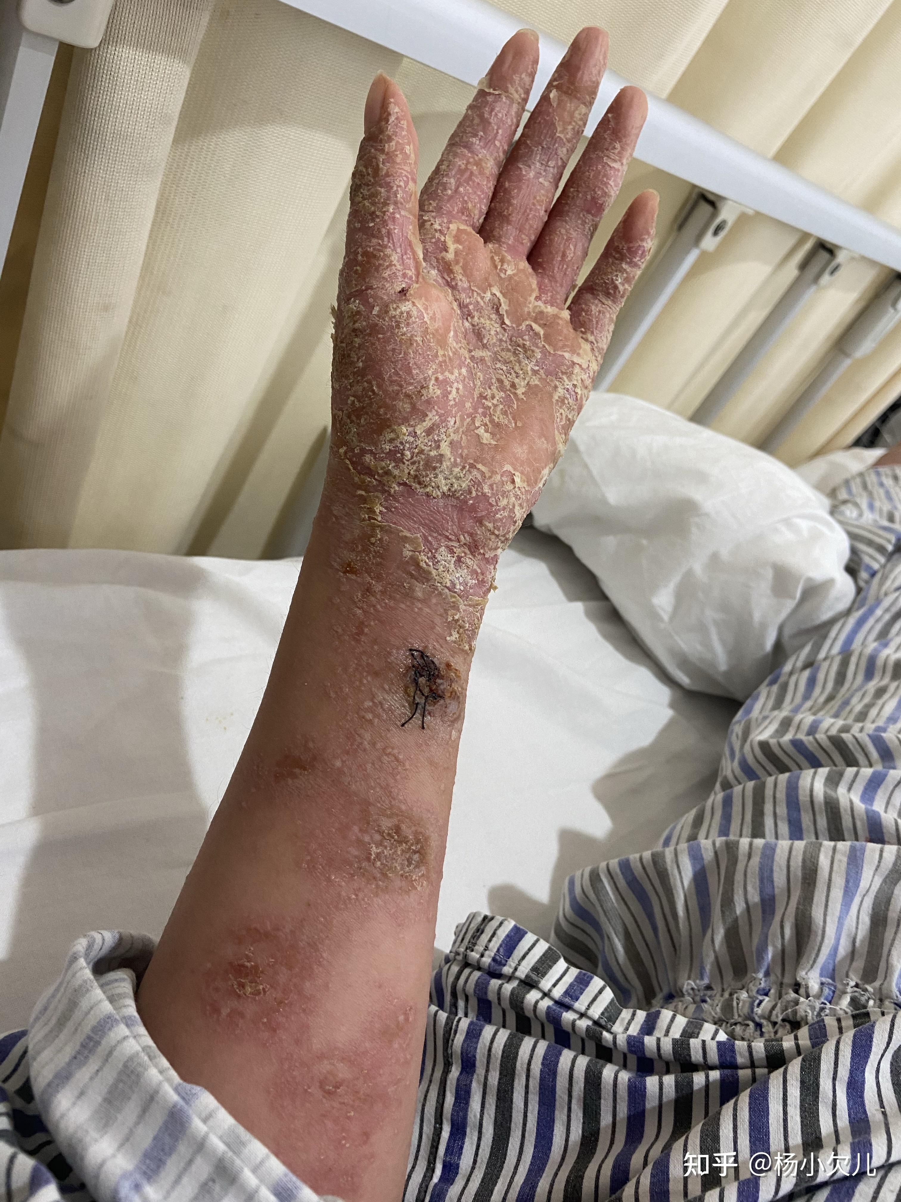 生物制剂治疗强直引发银屑病