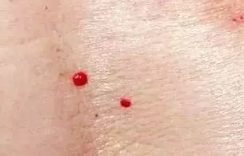 血痣,大病前兆!看你身上有没有? - 知乎