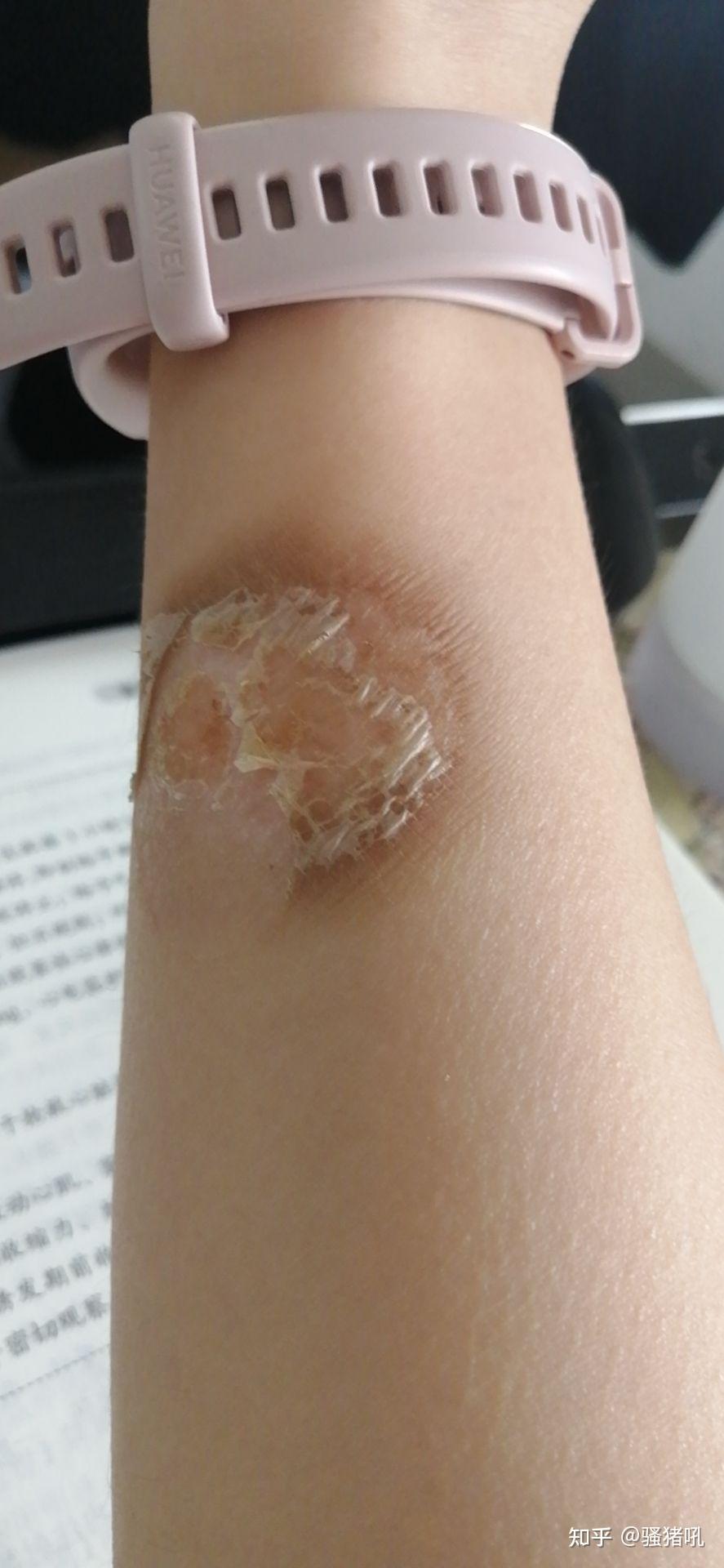 手被水蒸气烫伤怎么处置