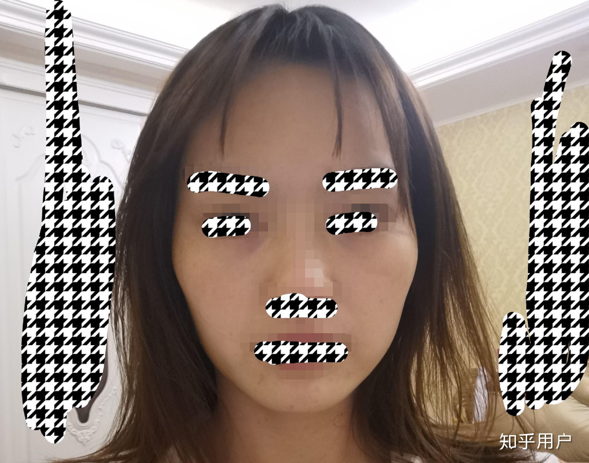 打瘦脸针失败了脸颊凹陷成了葫芦脸现在的我还可以做些什么