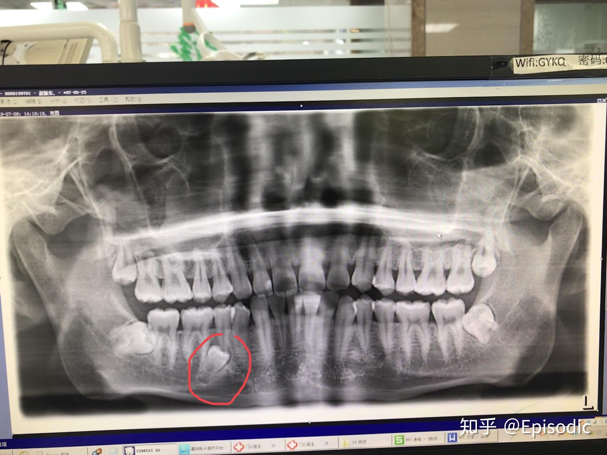 最近开始萌发智齿了结果牙龈特别疼