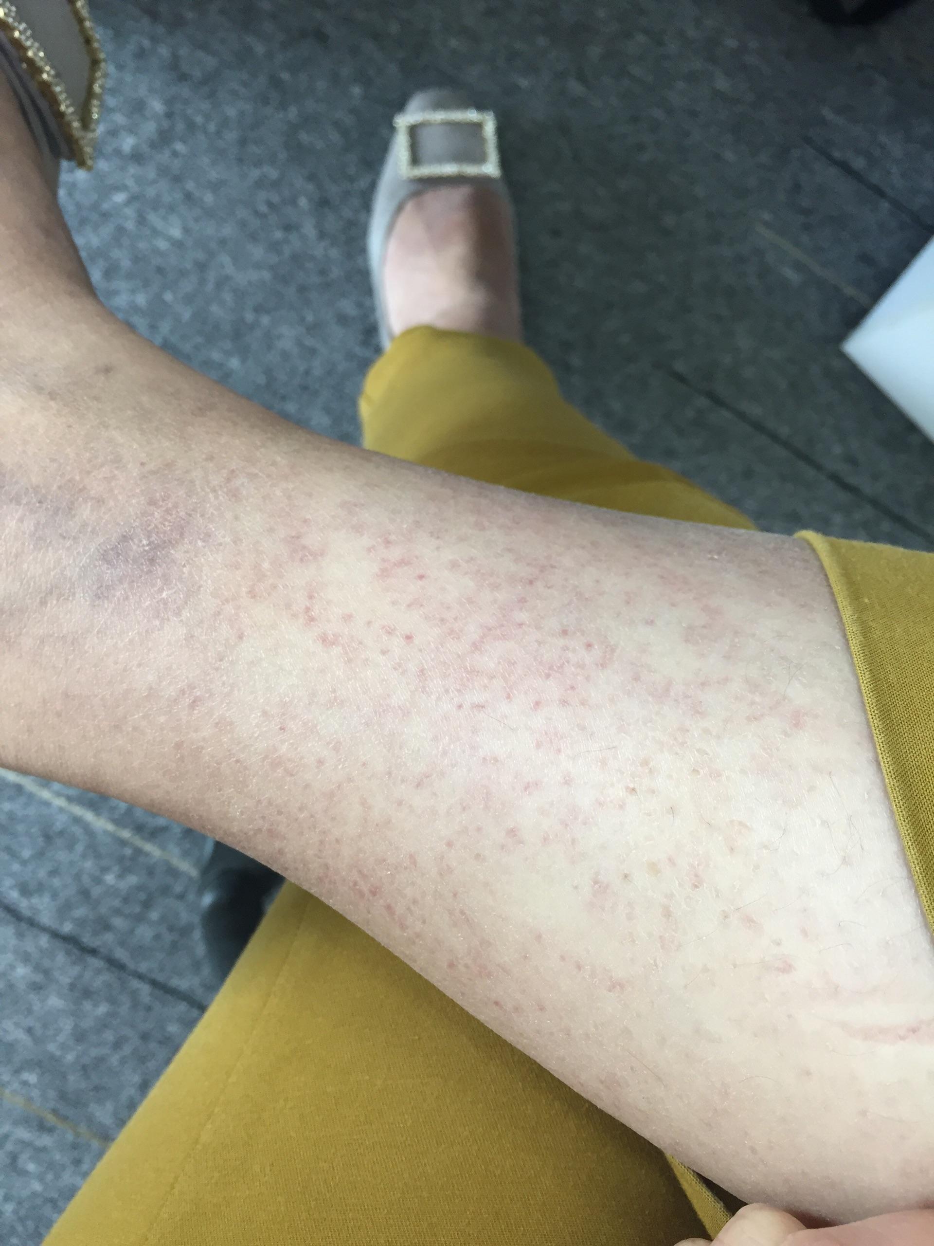 成人过敏性紫癜有痊愈的吗? - 知乎