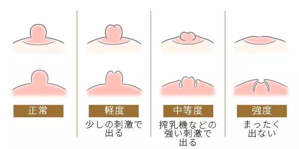 正常乳头为圆柱状,伸出于乳房平面约是1