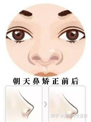 朝天鼻怎么形成的?又该如何矫正? - 知乎