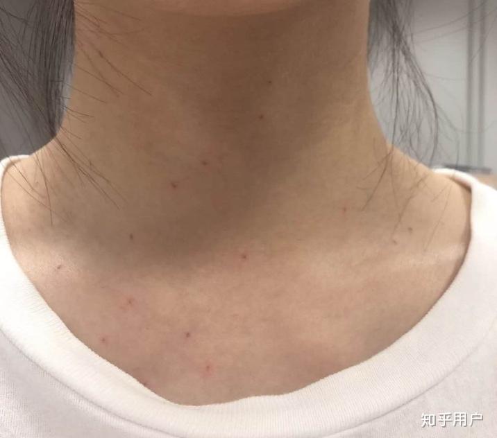 脖子为什么长疣子？ - 知乎
