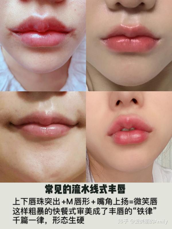 并配了好听的名字"微笑唇"喜欢把唇珠打得凸凸的