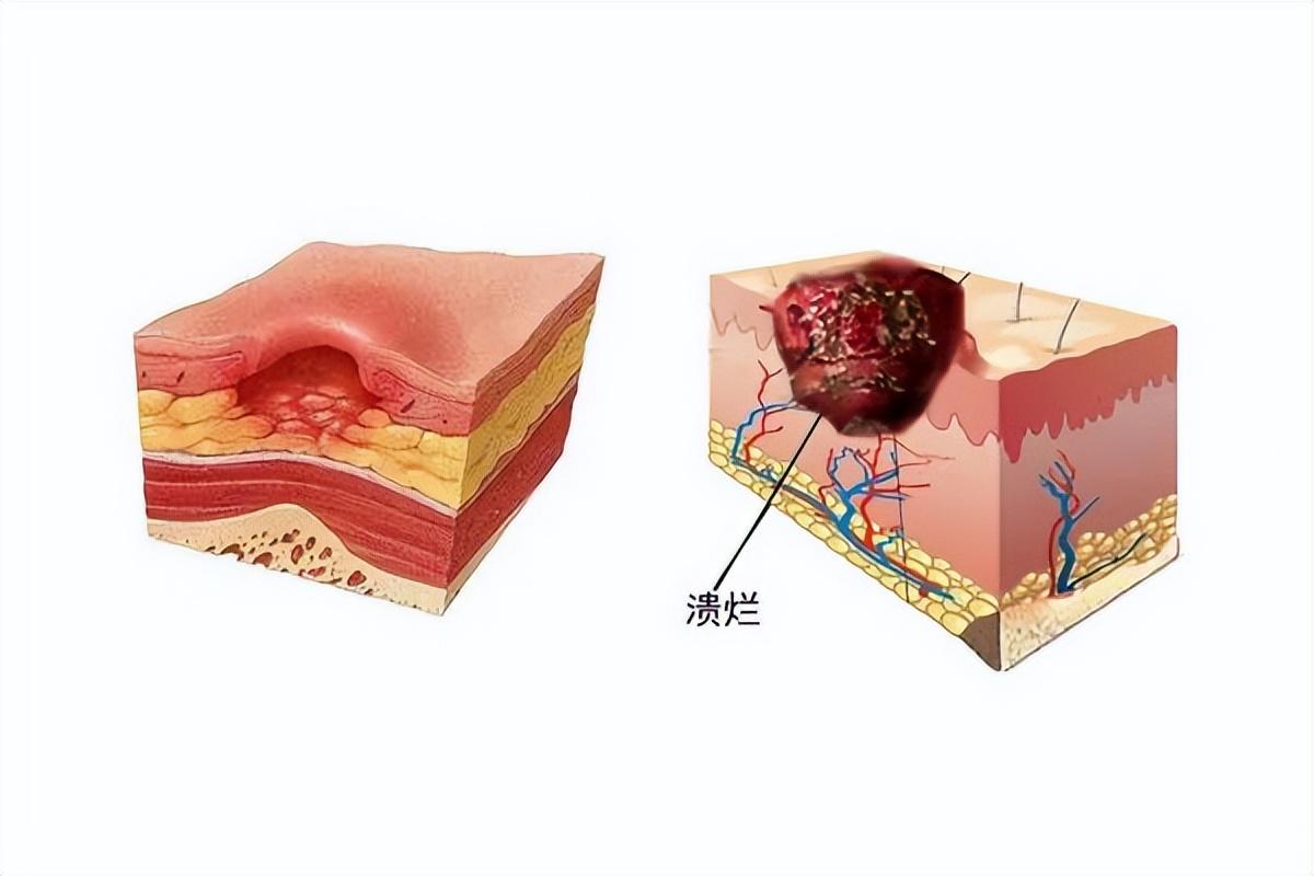护理大讲堂褥疮压疮的分期与护理方法