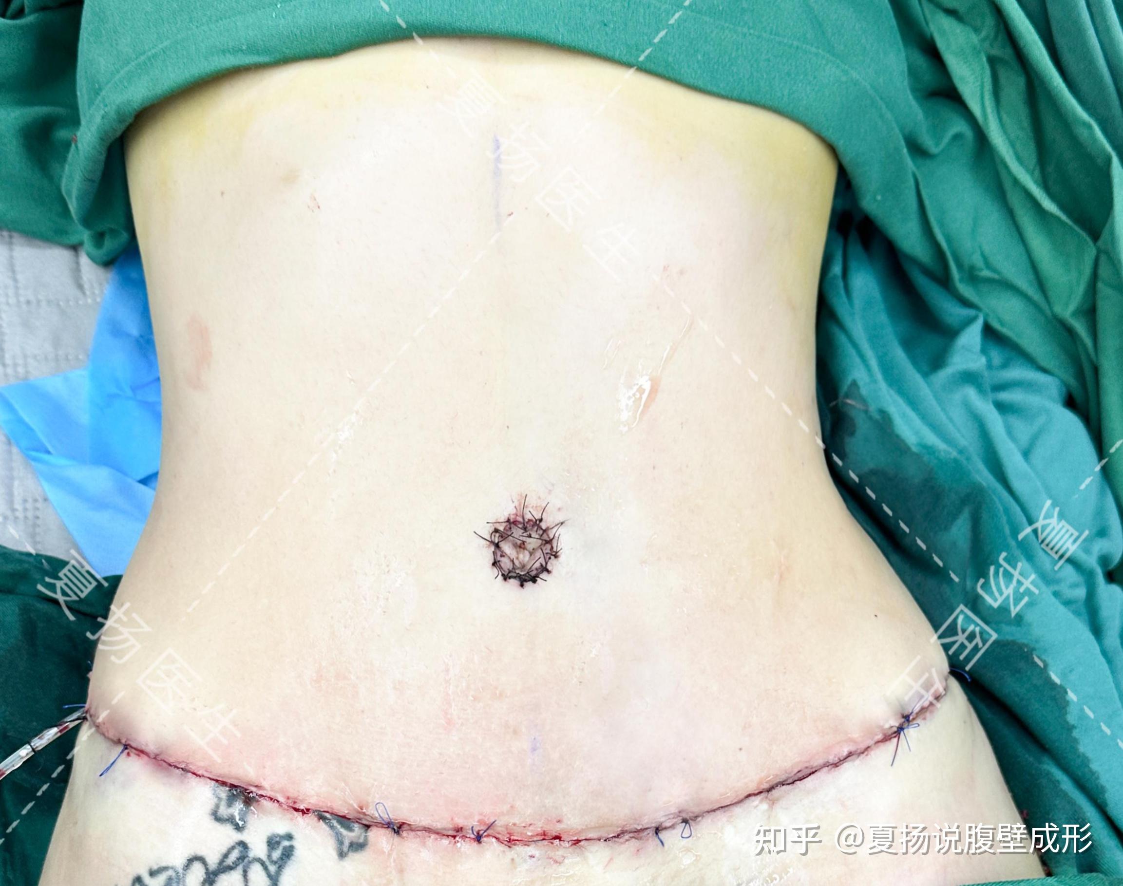 产后妈妈的最爱腹壁成形完美解决肚子松弛缩小腰围