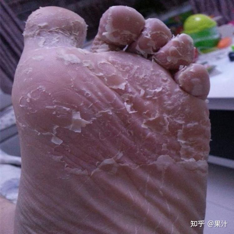 脚气是什么为什么我得了脚气