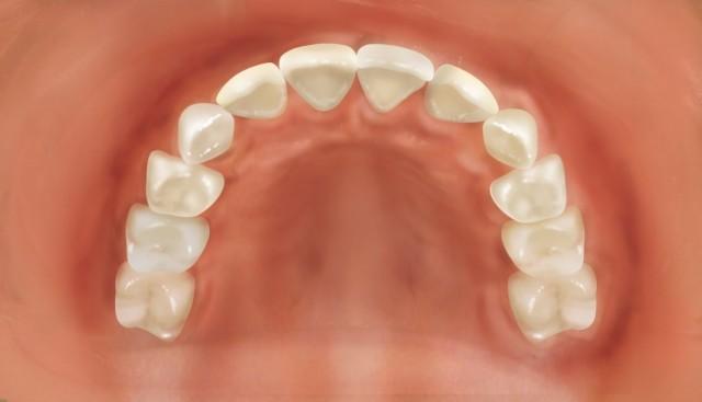 型腭:乳尖牙处于中间位置,腭处沿着牙弓平滑地成u字形展开.