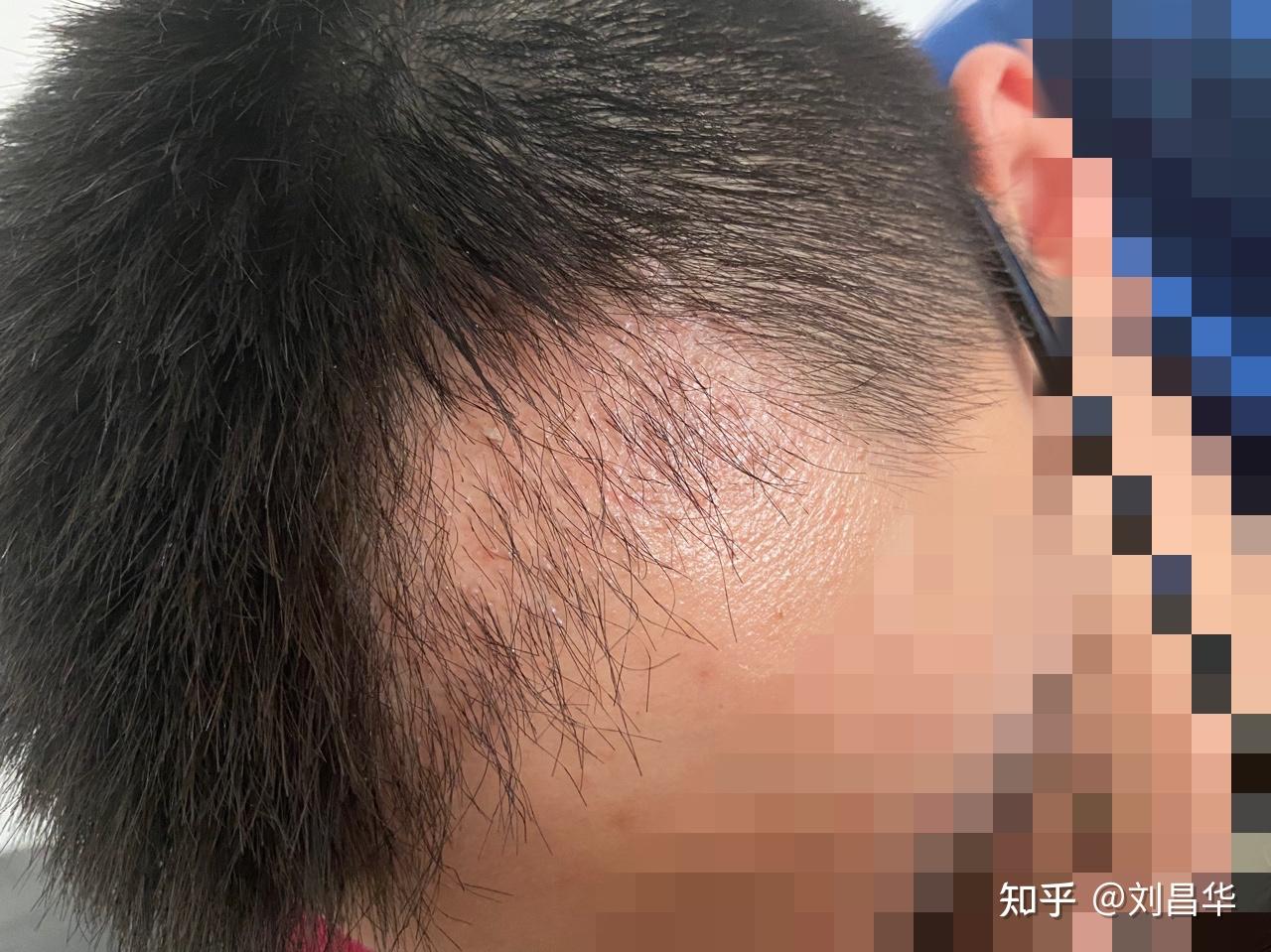 植发后发根发白(植发后发根有白色东西)