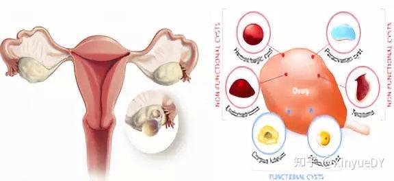 ③约10%的卵巢肿瘤会发生蒂扭转,好发于瘤蒂较长,中等大小