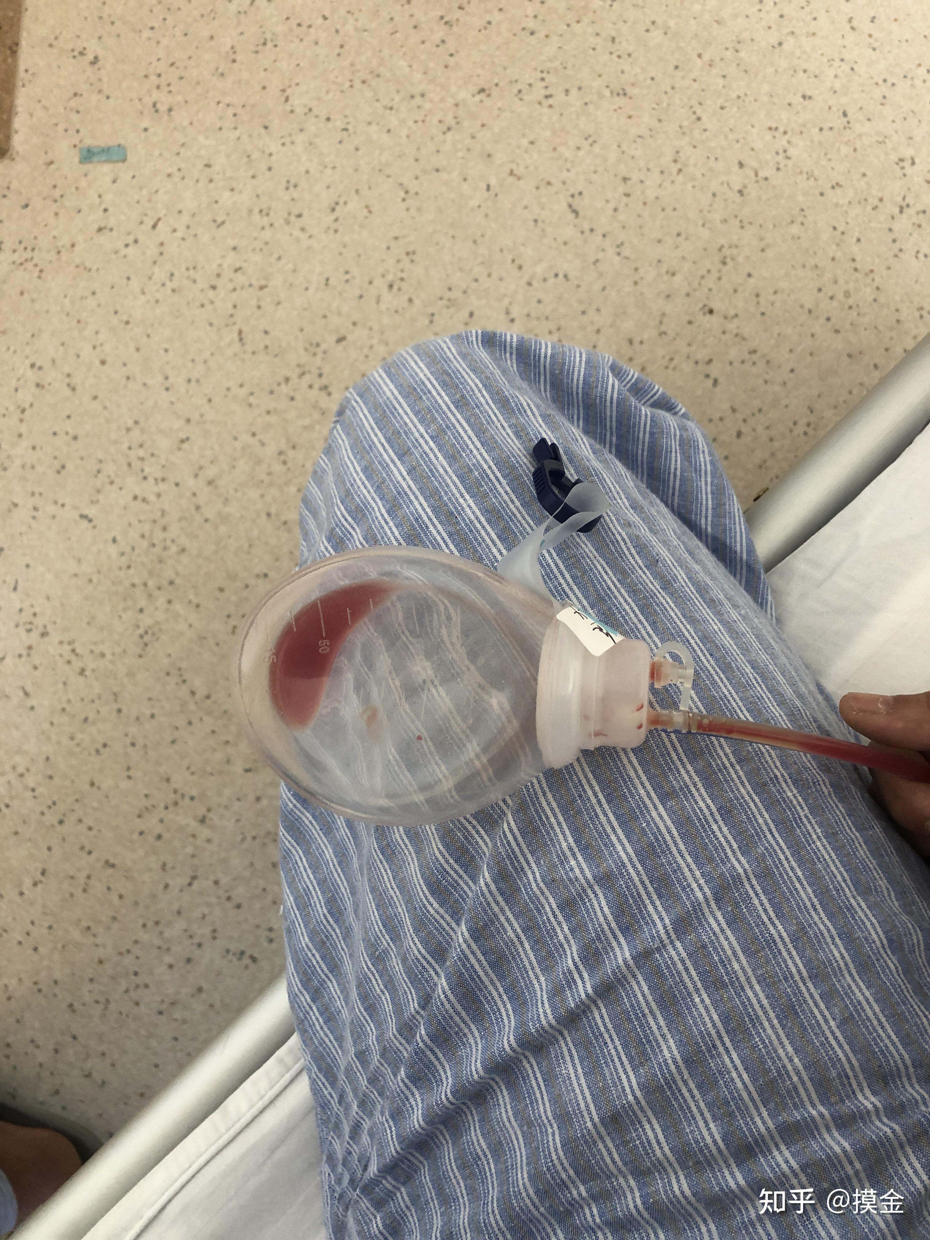 撤除束身衣,准备出院看出院证明才知道自己的手术类型术前术后对比