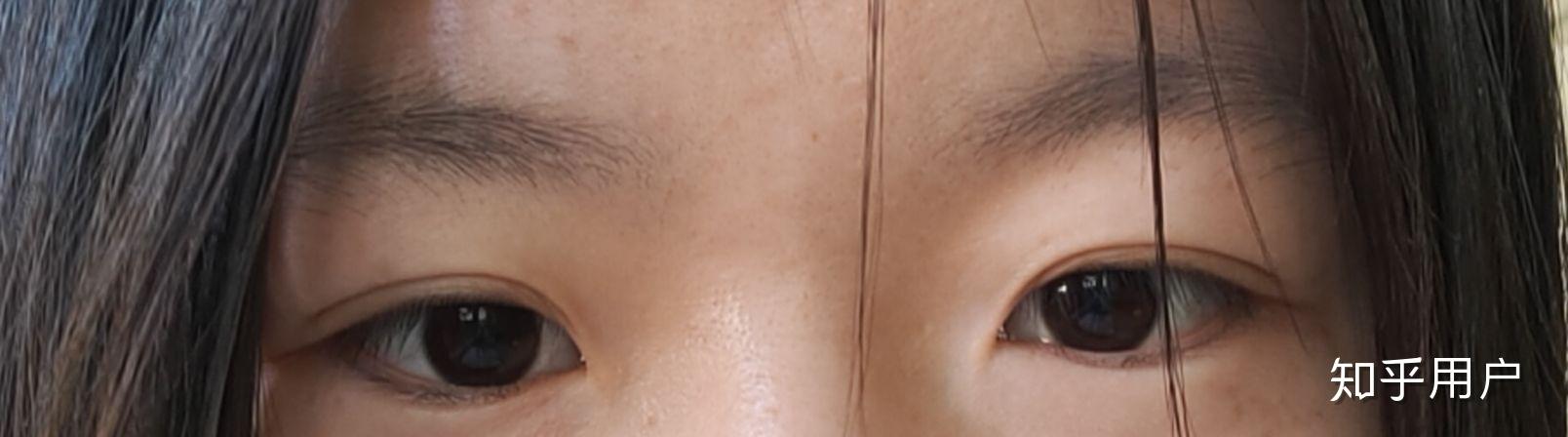 眼睛一高一低该怎么办? - 知乎