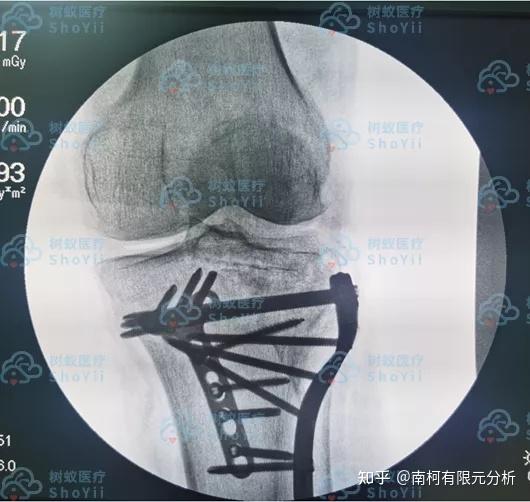 精准外科助力陆丰市第二人民医院重建修复严重胫骨平台粉碎性骨折
