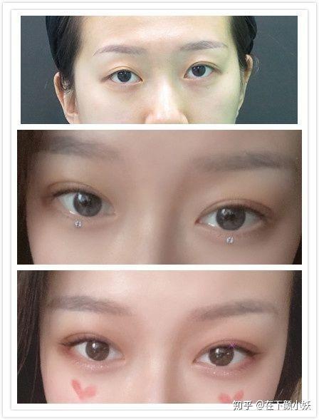 自然,化妆精致,整体反馈都不错手术以精细见长,每一台手术都严谨认真