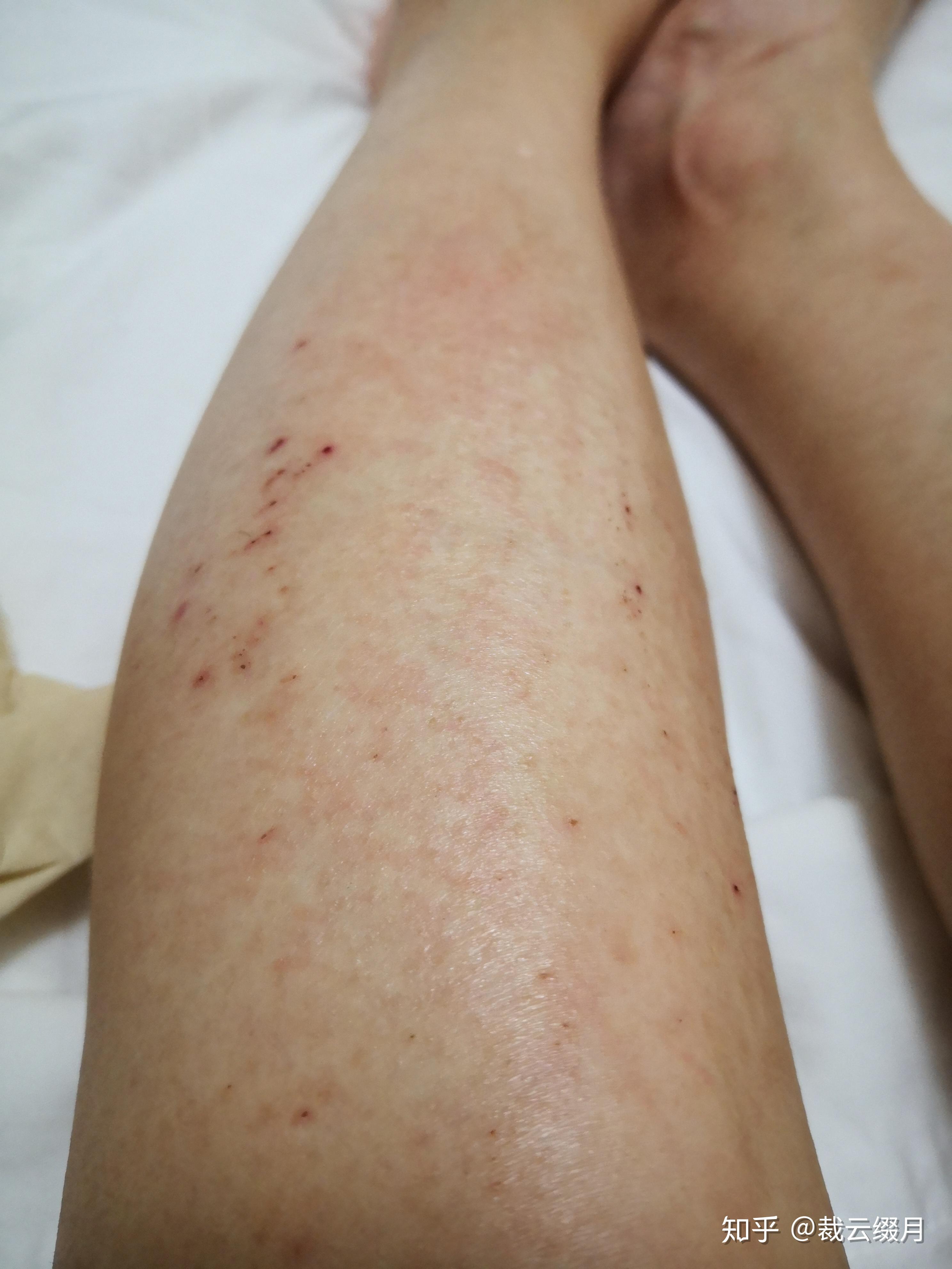 小腿特别痒,持续了两个月了,一直不好,越挠越痒挠破皮结了一腿的疤?
