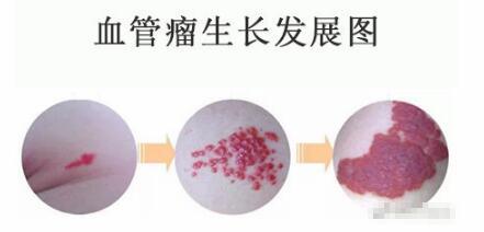 如何预防血管瘤复发 - 知乎