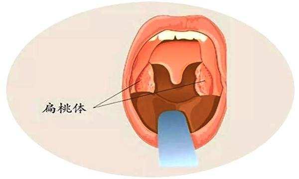 喉嚨痛喝蜂蜜怎麼喝扁桃體發炎蜂蜜有用嗎