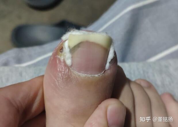 自述用棉棒和双氧水治疗甲沟炎的过程