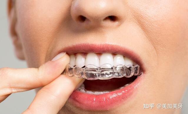 医生也许会根据患者病例的不同,选择用固定保持器,也就是在牙齿上粘接