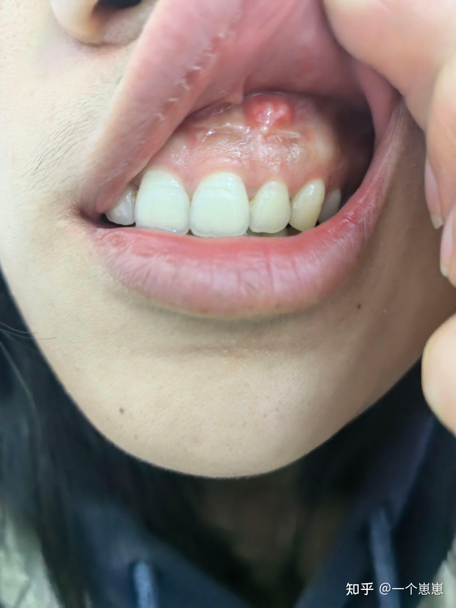 请问我的牙龈边上长了个硬包,是怎么回事呢?