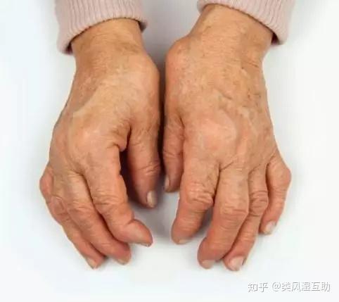 类风湿关节炎的病情发展过程