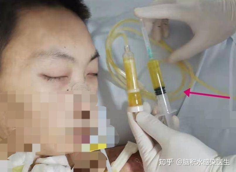 颅内感染却体温脑脊液正常谈一谈颅内感染中的陷阱