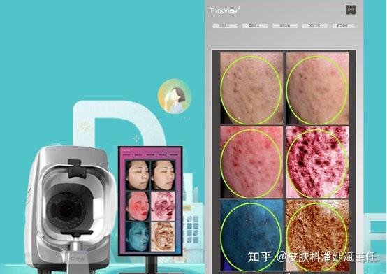 干货篇痤疮的治疗逻辑先治痘再痘印痘坑