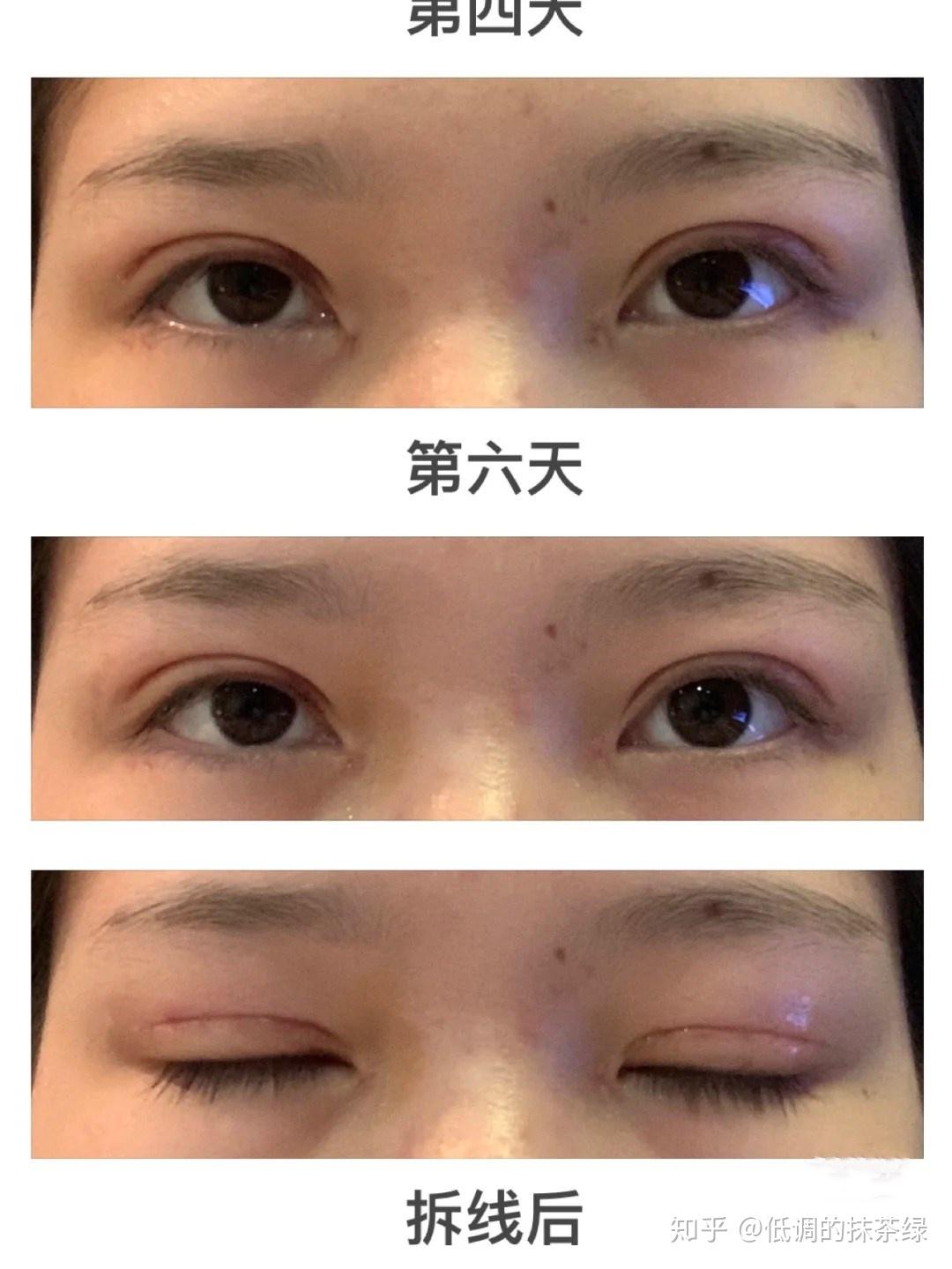 上海眼综合全切开眼角去皮去脂提肌费用1w左右