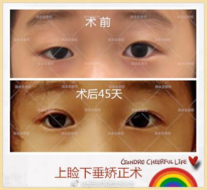 天生上眼睑下垂手术危险吗 眼睑下垂手术失败图片 北京上睑下垂术后再修复