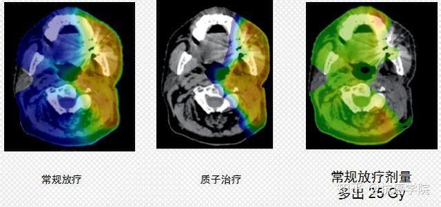 五年生存率8067新療法給髓母細胞瘤患者帶來治癒希望