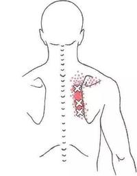肩胛筋膜炎的症状图片图片