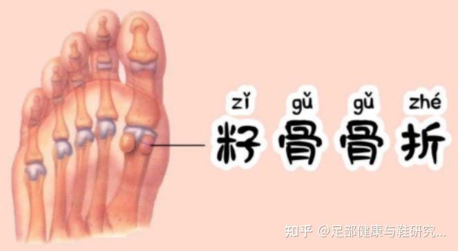 运动损伤，警惕籽骨炎 - 知乎