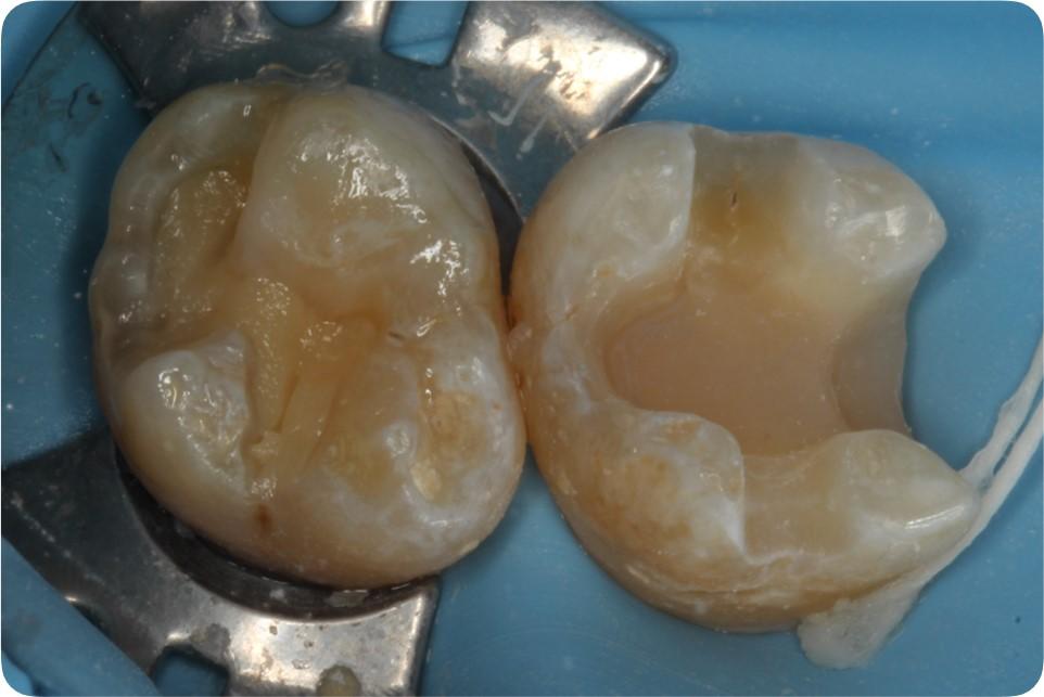 嵌体节优秀病例展示树脂嵌体
