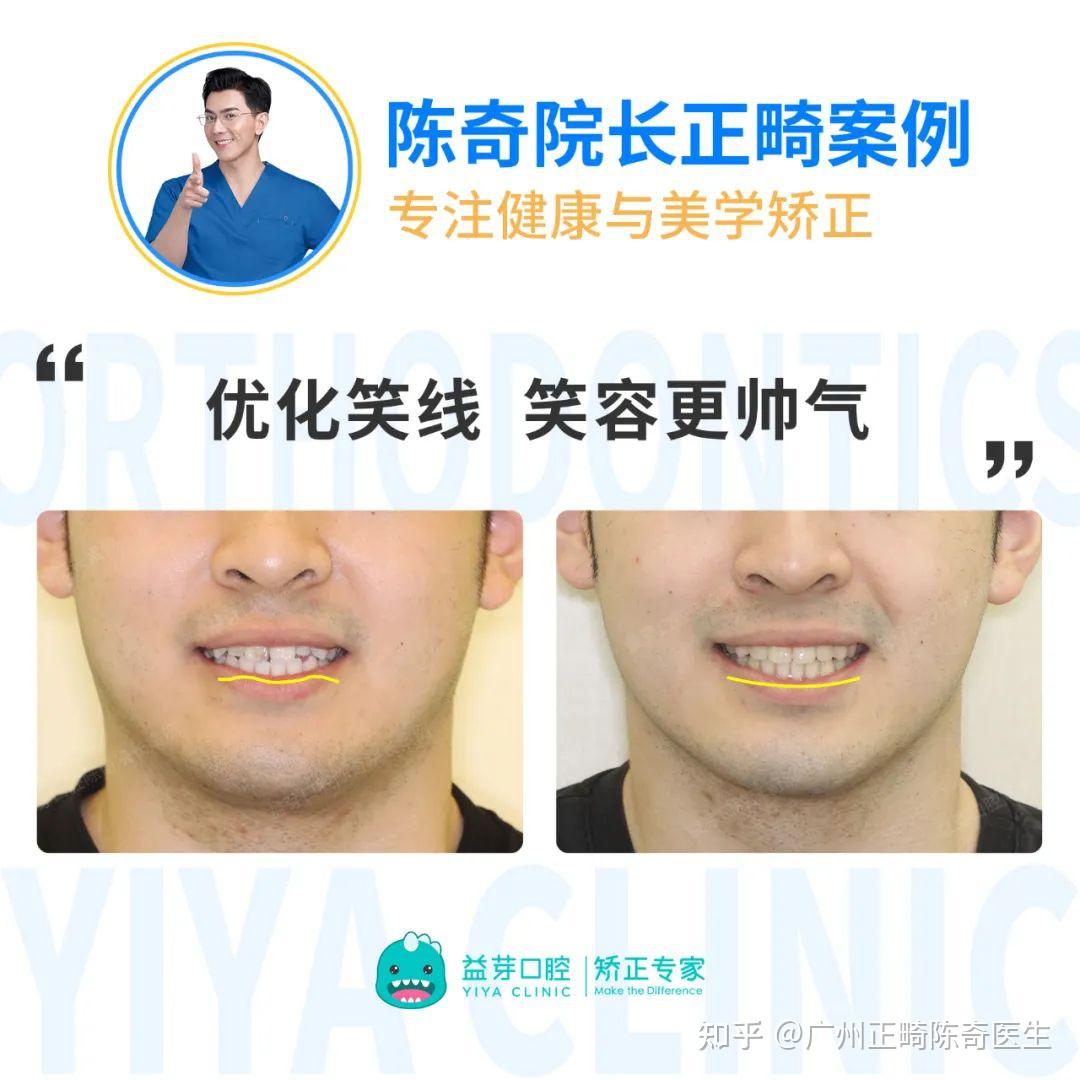 【正畸美学】揭秘“笑线”给笑容带来的变化！一起解锁自信笑容 - 知乎