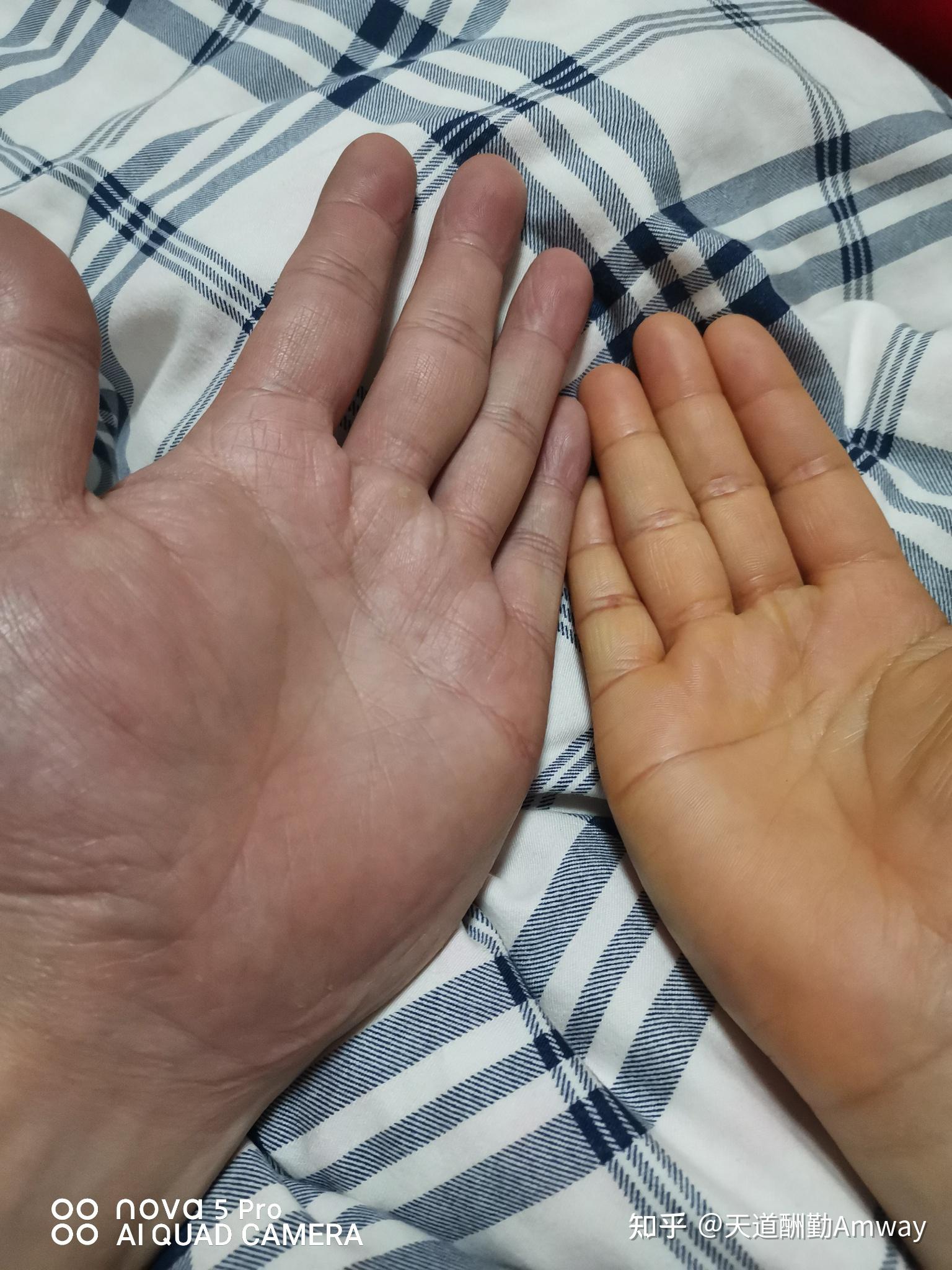 手脚发黄但身体正常是怎么回事? - 知乎