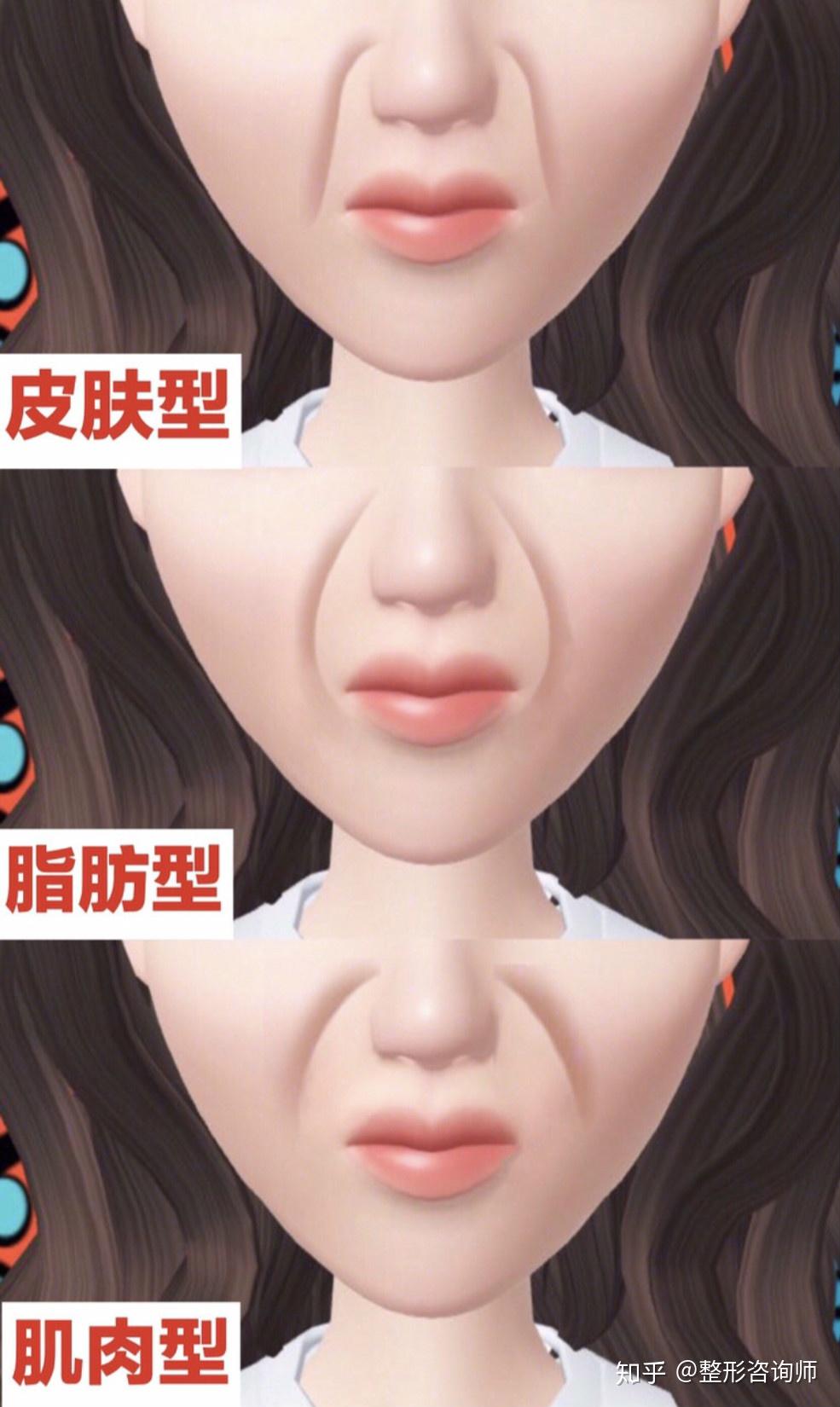 减少法令纹的脸部运动 v2-dfce289e7197c4d5aa5718081ed47720_r.jpg