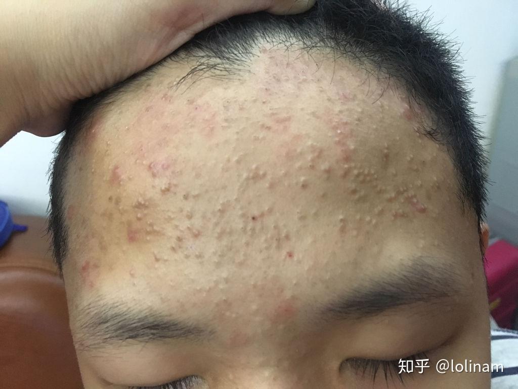 请教挤闭口的正确手法? - 知乎