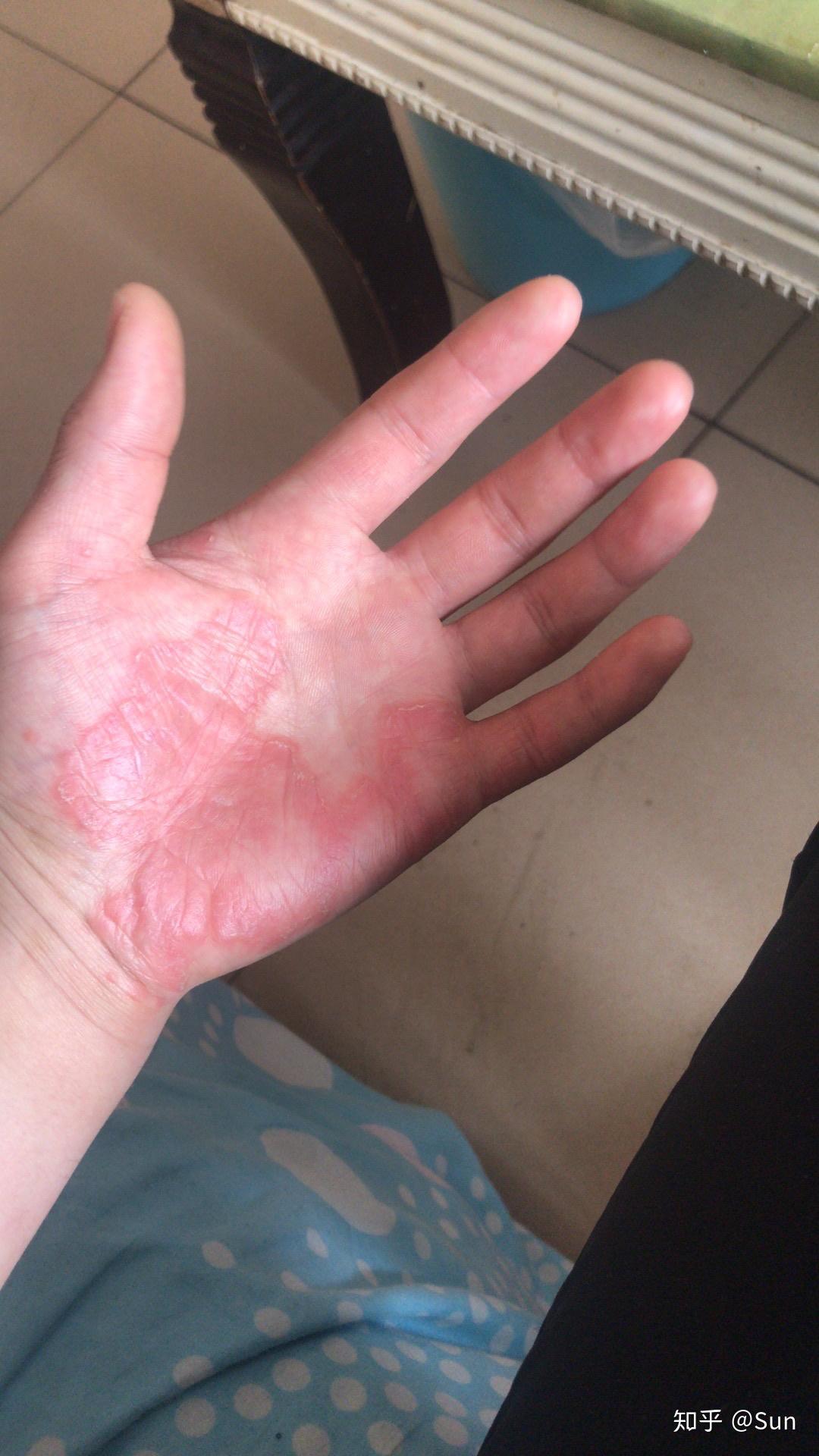 手掌到冬天就掉皮是怎么回事?