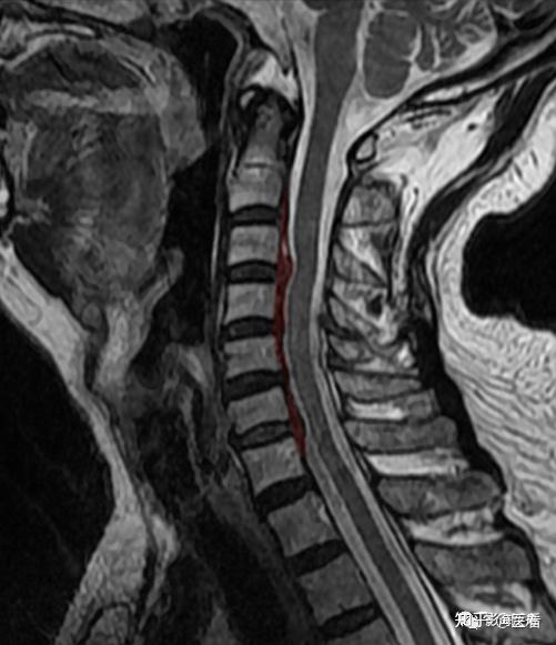 典型病例——颈椎后纵韧带钙化(mr)