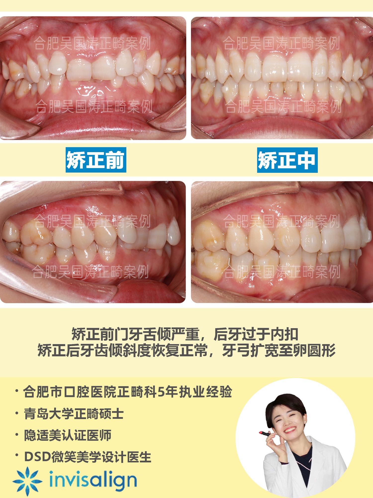 因此我為她設計了擴弓 推磨牙向後的隱適美矯正方案,可以看到患者矯正