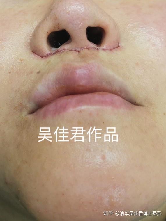 99的人不懂人中长的辛酸